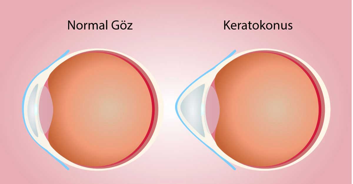 Keratokonus - Normal göz ve keratokonus karşılaştırma illüstrasyonu